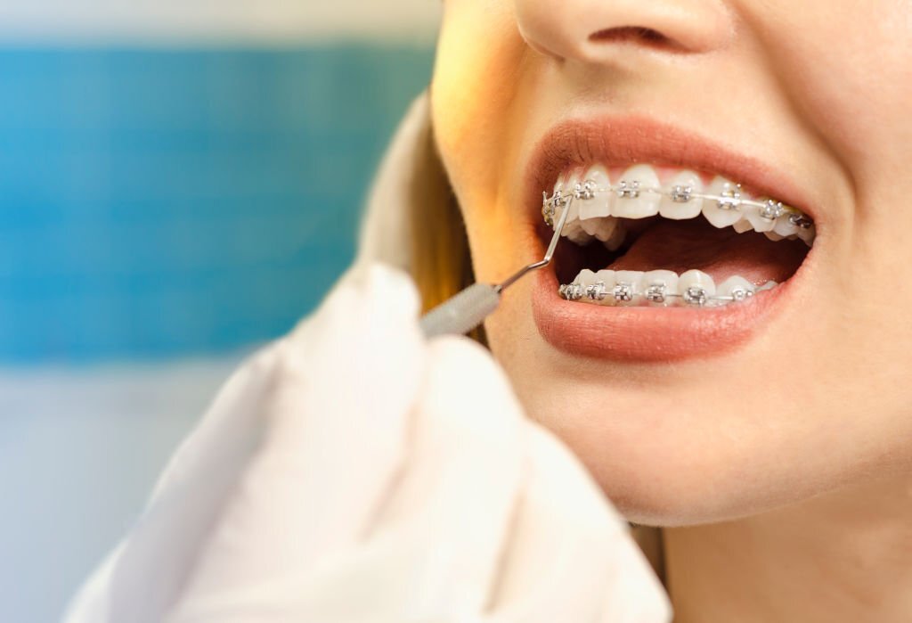 Orthodontic Treatment