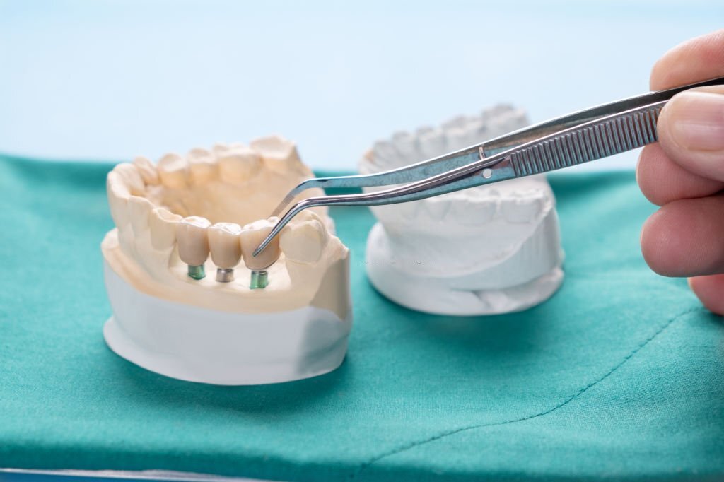 The Benefits of a Dental Bridge for Missing Teeth