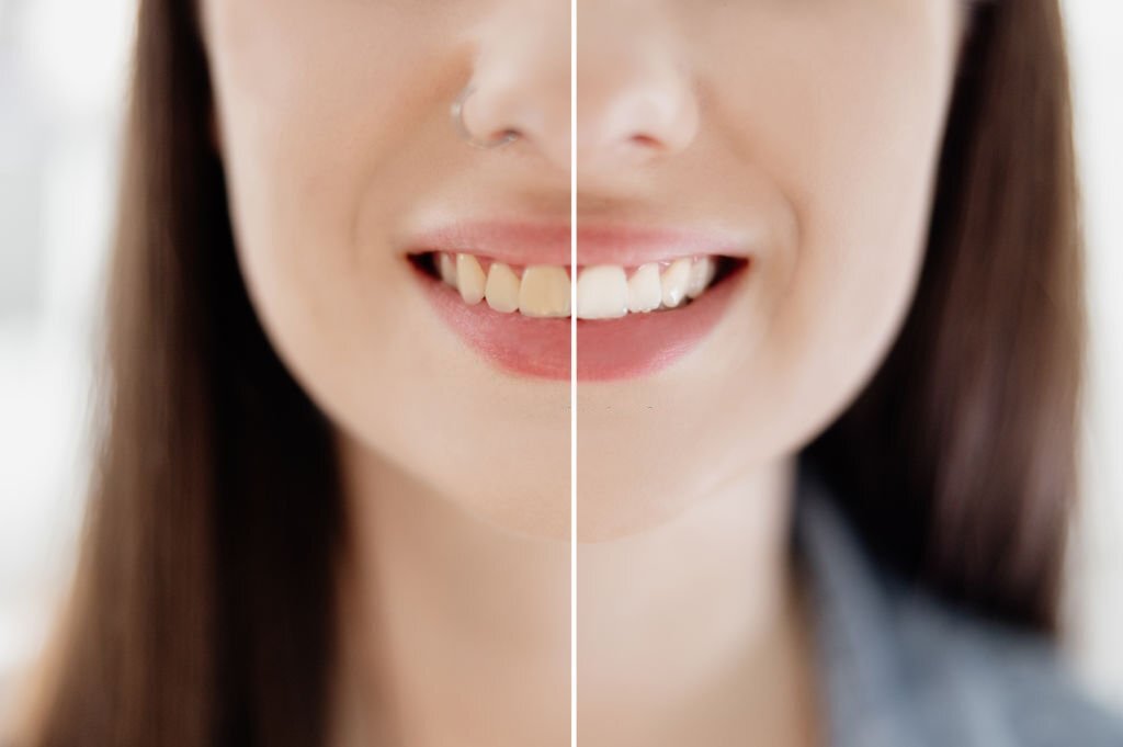 Teeth Whitening Methods