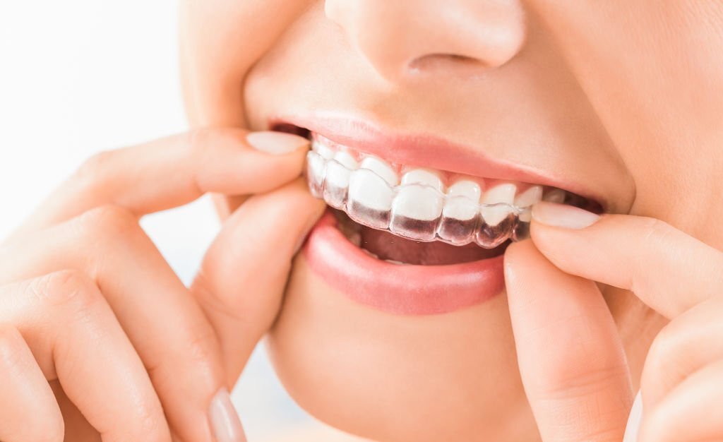 The Remarkable Benefits of Invisalign Braces