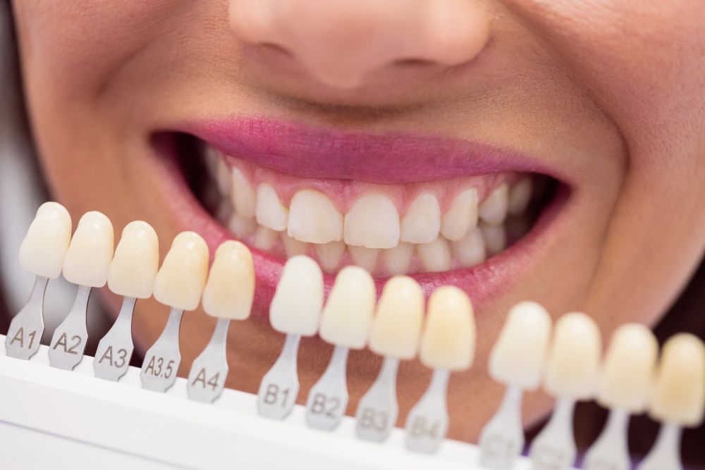 The Risks of DIY Teeth Whitening 