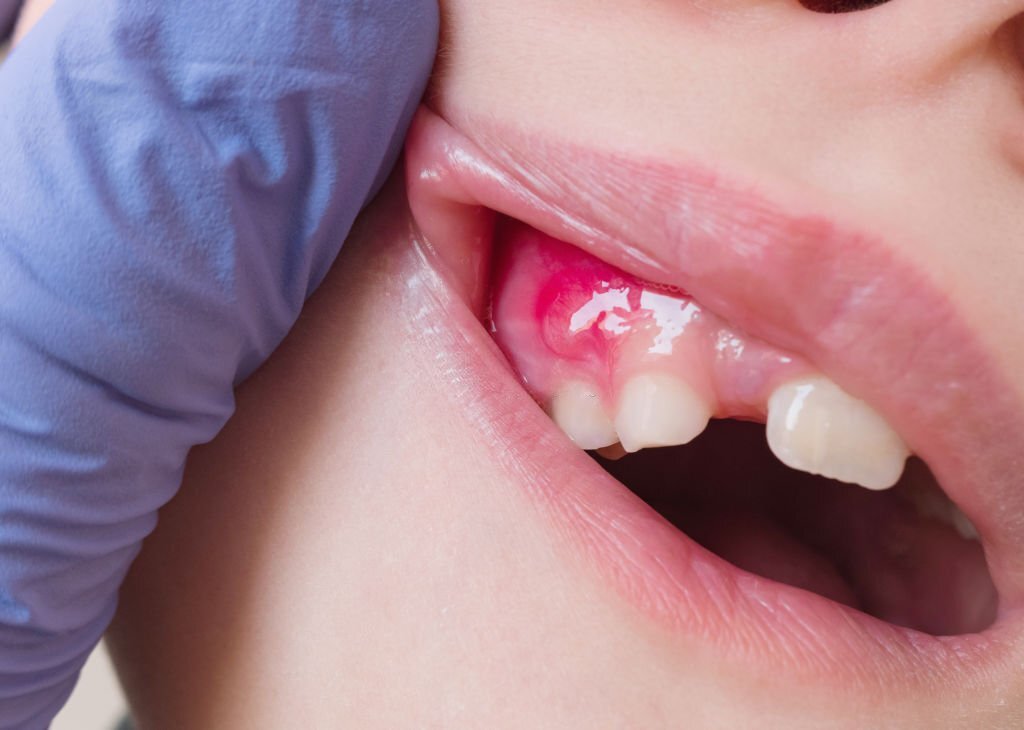 Tooth Abscesses