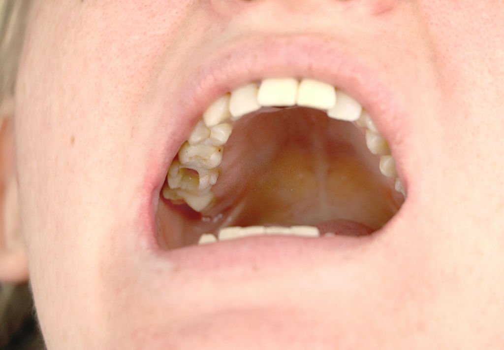 Tooth Sensitivity with Gum Recession