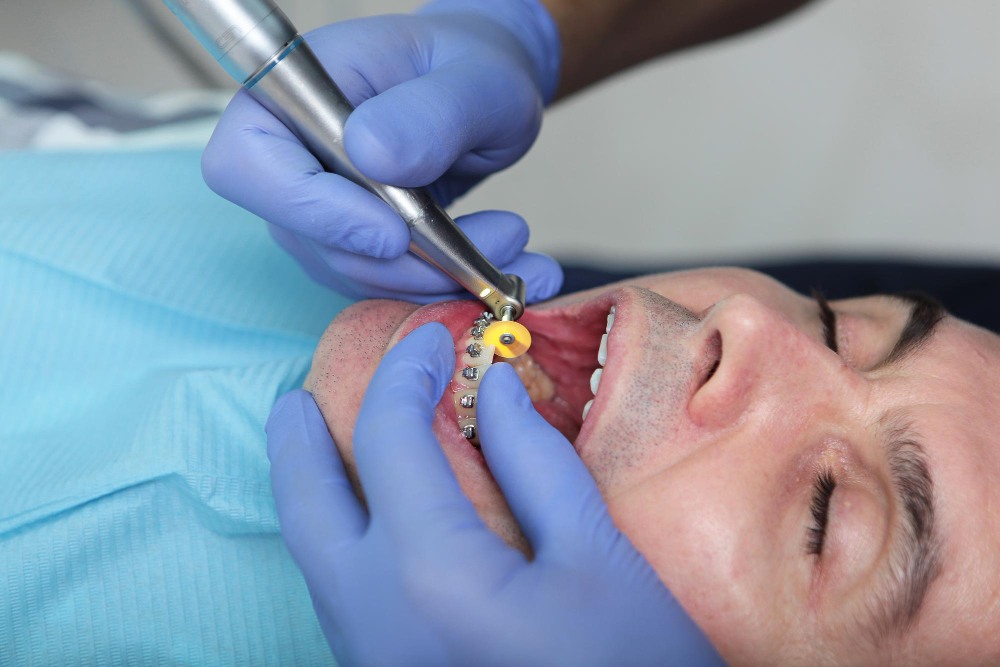 When to Replace Your Gold Tooth Filling