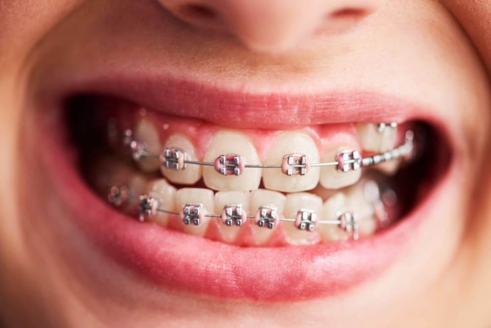 Braces