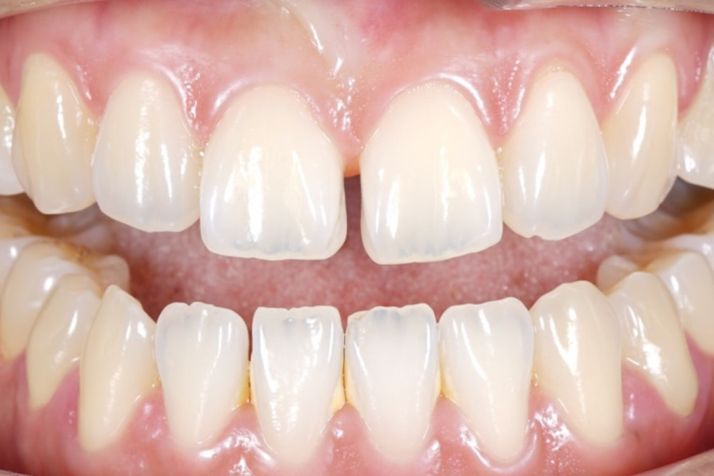 Introduction to Gaps Between Teeth