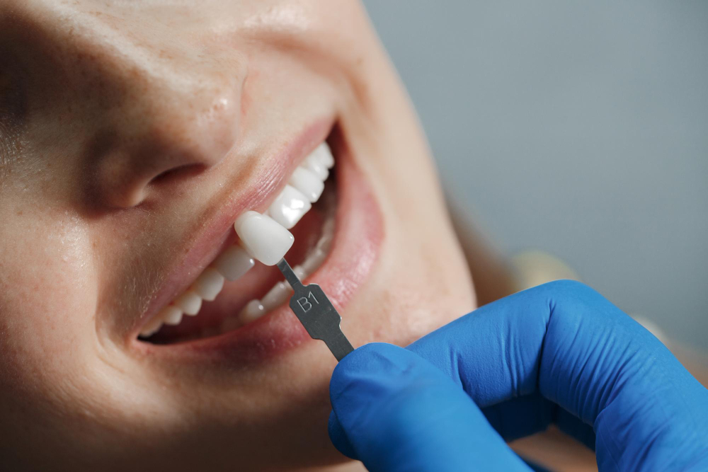 Composite Resin Fillings